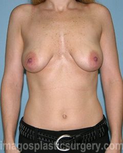 before front view breast lift of female patient 3648