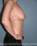 before right side view breast lift of female patient 3648
