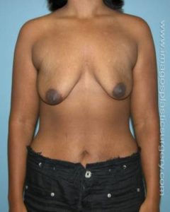 Before breast lift front case 3742