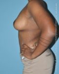 After breast lift left side case 3742