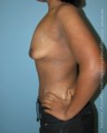 Before breast lift left side case 3742
