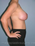 After breast lift right side case 3820