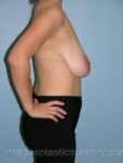 Before breast lift right side case 3820
