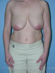After breast lift front view case 3865