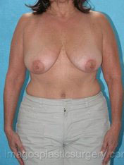 Before breast lift front view case 3892