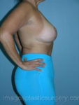 After breast lift right side case 3892