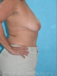 Before breast lift right side case 3892