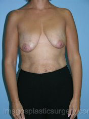 Before breast lift front view case 3898