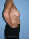 Before breast lift right side case 3898