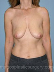 Before breast lift front view case 3903