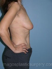 Before breast lift right side case 3903