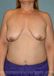 Before breast lift front view case 3916