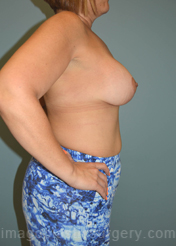 After breast lift right side case 3916