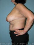 Before breast lift left side case 3921
