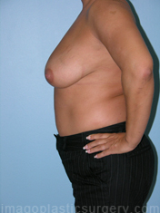 Before breast lift left side case 3933