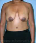 Before breast lift front view case 3940
