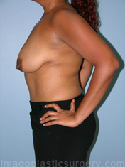 Before breast lift left side case 3940