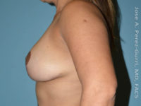 After breast right right side case 3956
