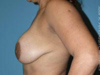 Before breast lift left side case 3956