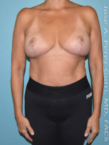 After breast lift front view case 3976
