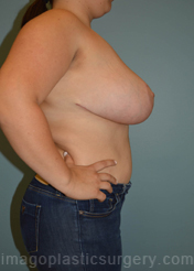 After breast reduction right side view case 4135