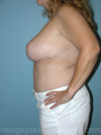 After breast reduction left side view case 4140