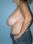 Before breast reduction left side view case 4140