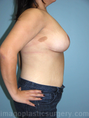 After breast reduction right side view case 4146