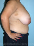 Before breast reduction right side view case 4146