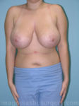 Before breast reduction front view case 4156
