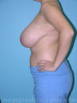 Before breast reduction left side view case 4156
