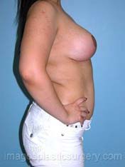 After breast reduction right side view case 4184