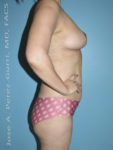After breast reduction right side view case 4194