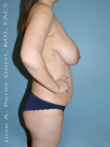 Before breast reduction right side view case 4199