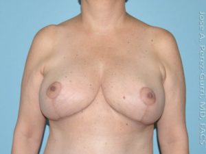 After breast reduction left side view case 4220