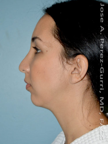 before left side view chin augmentation of female patient 2479