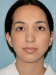 before front view chin augmentation of female patient 2479