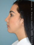 after left side view chin augmentation of female patient 2479