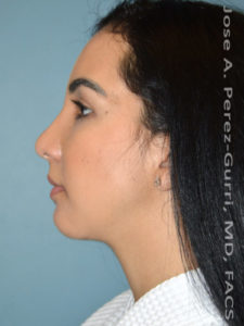 after left side view chin augmentation of female patient 2479