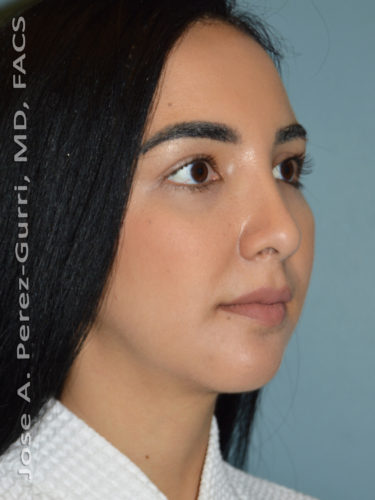 after right angle view chin augmentation of female patient 2479