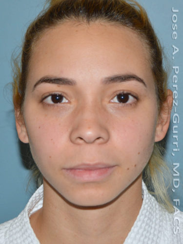 before front view chin augmentation of female patient 2486