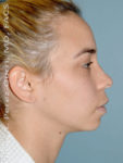 before right side view chin augmentation of female patient 2486