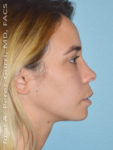 after right side view chin augmentation of female patient 2486