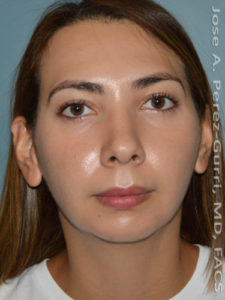 before front view chin augmentation of female patient 2491