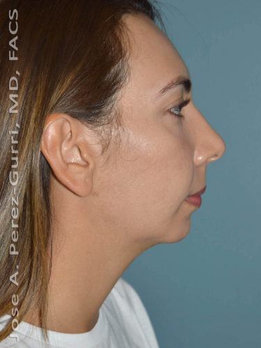 before right side view chin augmentation of female patient 2491
