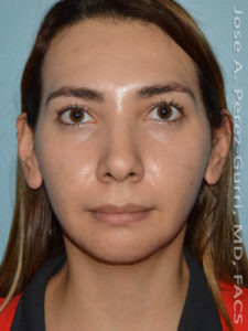after front view chin augmentation of female patient 2491