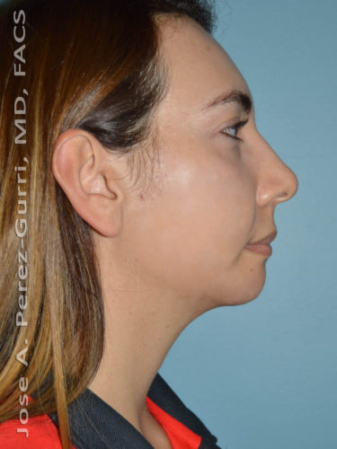 after right side view chin augmentation of female patient 2491