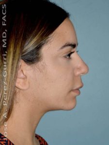 before right side view chin augmentation of female patient 2496