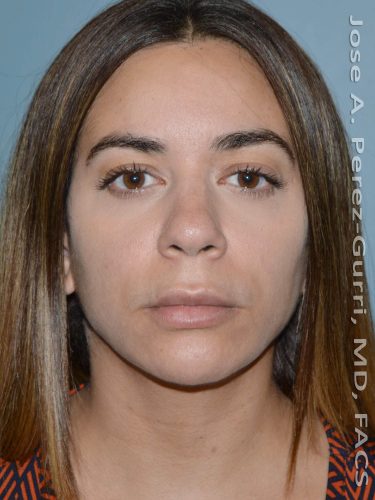 before front view chin augmentation of female patient 2496