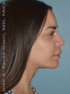 after right side view chin augmentation of female patient 2496